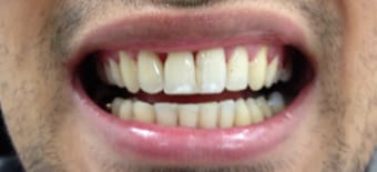 After cosmetic Treatment Smile Rooms Glasgow After cosmetic Treatment Smile Rooms Glasgow