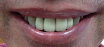 After Veneers Treatment Smile Rooms Glasgow After Veneers Treatment Smile Rooms Glasgow