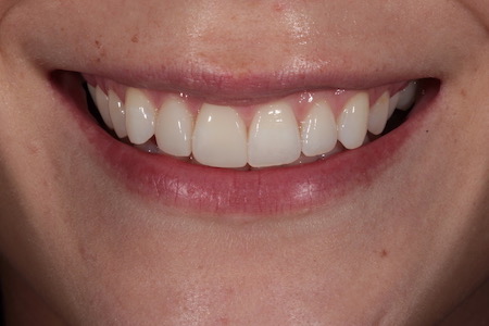 After Invisalign Treatment Smile Rooms Glasgow