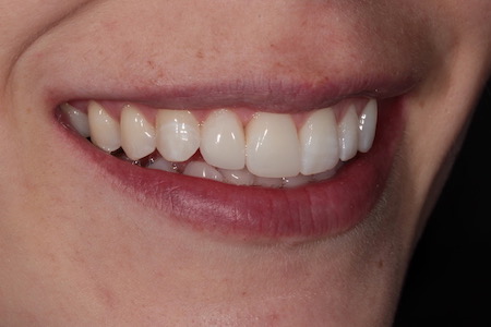 After Invisalign Treatment Smile Rooms Glasgow