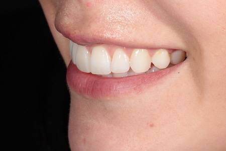 After Invisalign Treatment Smile Rooms Glasgow