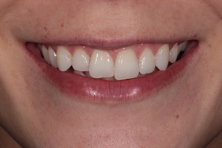 Before Invisalign Treatment Smile Rooms Glasgow