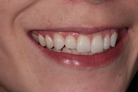 Before Invisalign Treatment Smile Rooms Glasgow