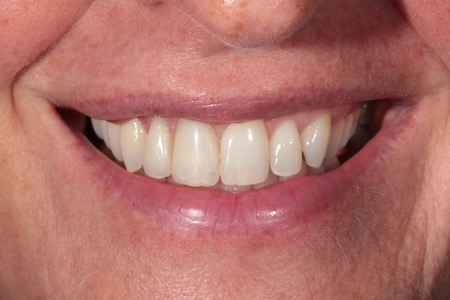 After Veneers Treatment Smile Rooms Glasgow After Veneers Treatment Smile Rooms Glasgow