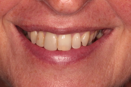 Before veneers Treatment Smile Rooms Glasgow Before veneers Treatment Smile Rooms Glasgow
