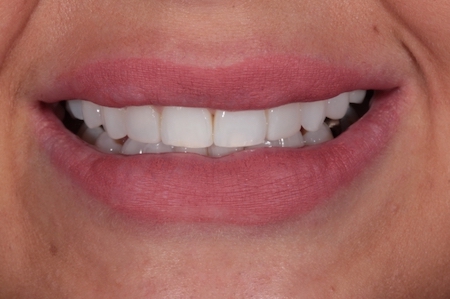 After Invisalign Treatment Smile Rooms Glasgow