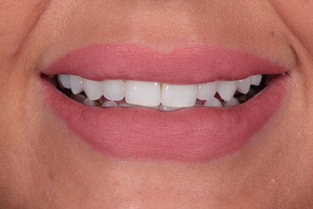 Before Invisalign Treatment Smile Rooms Glasgow