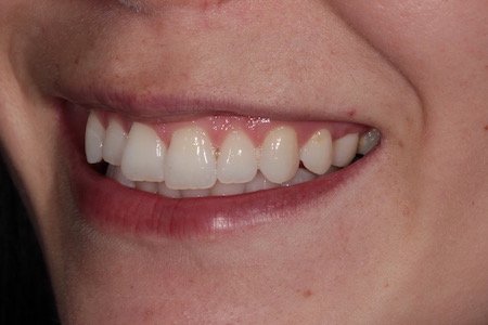 Before Invisalign Treatment Smile Rooms Glasgow