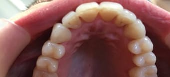 After cosmetic Treatment Smile Rooms Glasgow After cosmetic Treatment Smile Rooms Glasgow