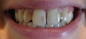 Before veneers Treatment Smile Rooms Glasgow Before veneers Treatment Smile Rooms Glasgow