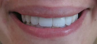 After Veneers Treatment Smile Rooms Glasgow After Veneers Treatment Smile Rooms Glasgow