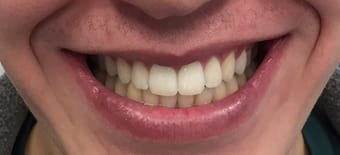 After Smile Makeover Treatment Smile Rooms Glasgow After Smile Makeover Treatment Smile Rooms Glasgow