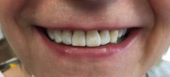 After Smile Makeover Treatment Smile Rooms Glasgow After Smile Makeover Treatment Smile Rooms Glasgow