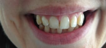 Before Smile Makeover Treatment Smile Rooms Glasgow Before Smile Makeover Treatment Smile Rooms Glasgow