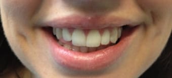 After Smile Makeover Treatment Smile Rooms Glasgow After Smile Makeover Treatment Smile Rooms Glasgow