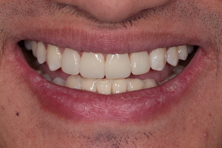 After Veneers Treatment Smile Rooms Glasgow After Veneers Treatment Smile Rooms Glasgow