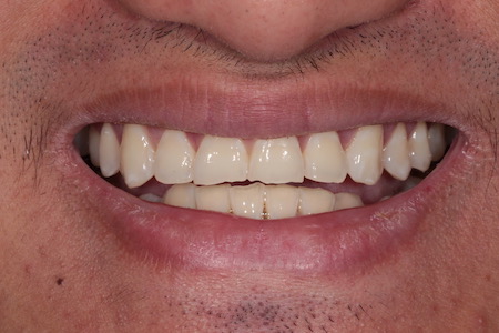 Before veneers Treatment Smile Rooms Glasgow Before veneers Treatment Smile Rooms Glasgow