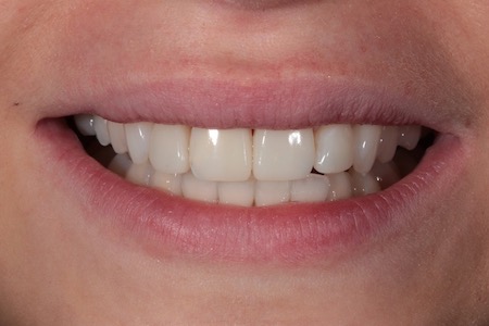 After Veneers Treatment Smile Rooms Glasgow After Veneers Treatment Smile Rooms Glasgow