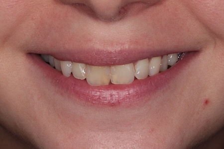 Before veneers Treatment Smile Rooms Glasgow Before veneers Treatment Smile Rooms Glasgow