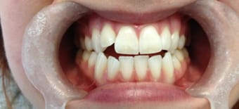 Before cosmetic Treatment Smile Rooms Glasgow Before cosmetic Treatment Smile Rooms Glasgow