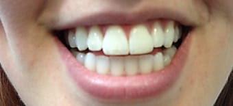 After cosmetic Treatment Smile Rooms Glasgow After cosmetic Treatment Smile Rooms Glasgow