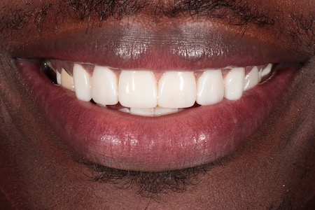 After Veneers Treatment Smile Rooms Glasgow After Veneers Treatment Smile Rooms Glasgow