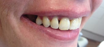 After Veneers Treatment Smile Rooms Glasgow After Veneers Treatment Smile Rooms Glasgow