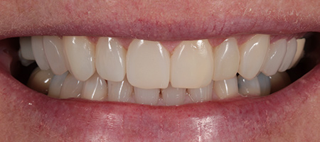 After Invisalign Treatment Smile Rooms Glasgow