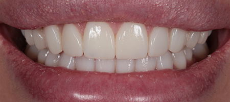 After Invisalign Treatment Smile Rooms Glasgow