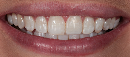 After Invisalign Treatment Smile Rooms Glasgow