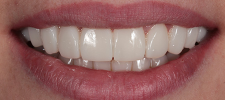 After Invisalign Treatment Smile Rooms Glasgow