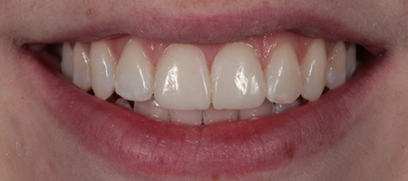 After Invisalign Treatment Smile Rooms Glasgow