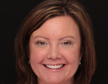 After Invisalign Treatment Smile Rooms Glasgow