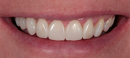 After Invisalign Treatment Smile Rooms Glasgow