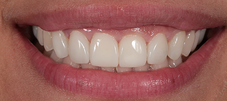 After Invisalign Treatment Smile Rooms Glasgow