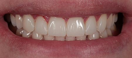 After Invisalign Treatment Smile Rooms Glasgow