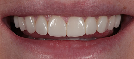 After Invisalign Treatment Smile Rooms Glasgow