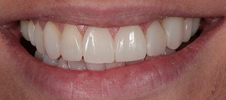After Invisalign Treatment Smile Rooms Glasgow