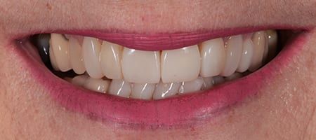 After Invisalign Treatment Smile Rooms Glasgow