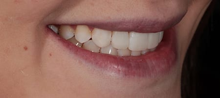 After Invisalign Treatment Smile Rooms Glasgow