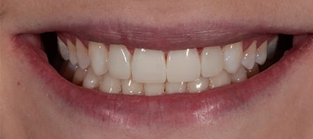 After Invisalign Treatment Smile Rooms Glasgow