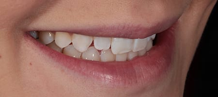 Before & after cosmetic bonding