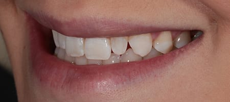 Before & after cosmetic bonding