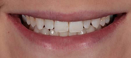 Before & after cosmetic bonding