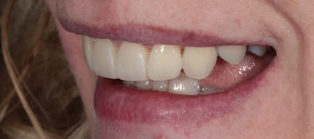 After Invisalign Treatment Smile Rooms Glasgow