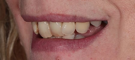 Before & after cosmetic bonding