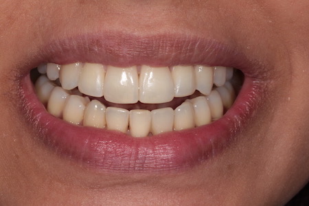 After Veneers Treatment Smile Rooms Glasgow After Veneers Treatment Smile Rooms Glasgow
