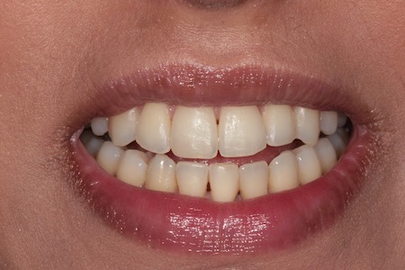 Before veneers Treatment Smile Rooms Glasgow Before veneers Treatment Smile Rooms Glasgow