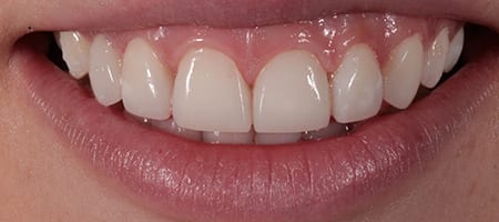 After Invisalign Treatment Smile Rooms Glasgow