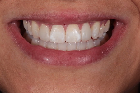After Invisalign Treatment Smile Rooms Glasgow